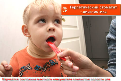 герпетический стоматит - диагностика