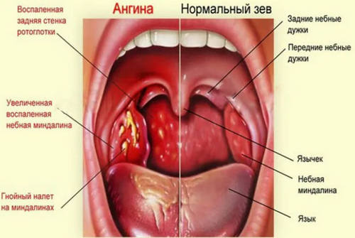 Миндалины - что это