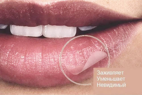 Можно ли клеить на корочку герпеса