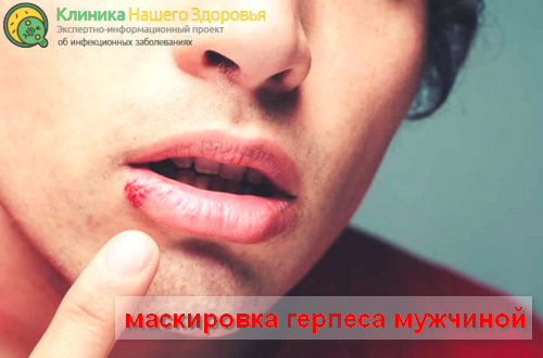 Как замаскировать герпес мужчине