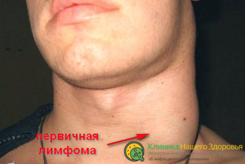 Первичная лимфома