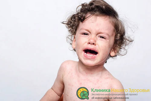 Герпес в крови у ребенка