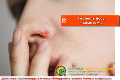 Герпес в носу - симптомы
