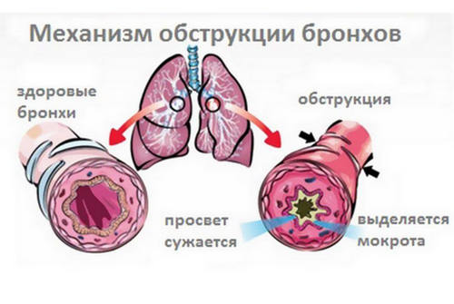 Классификация острого бронхита