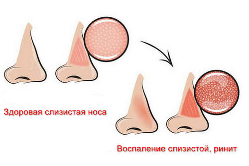 Ринит что это