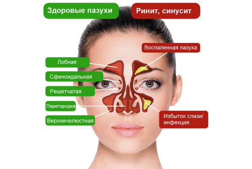 Ринит патогенез