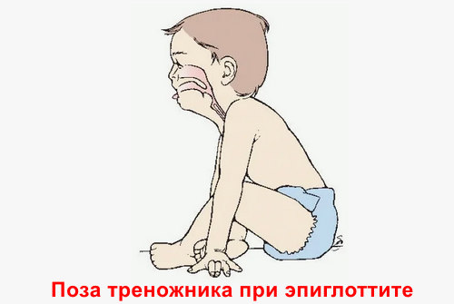 Симптомы эпиглоттита