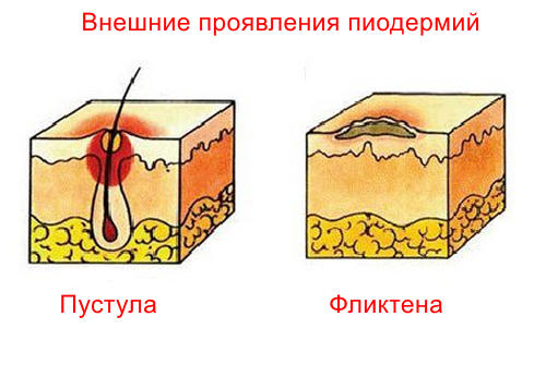 Что такое пиодермия
