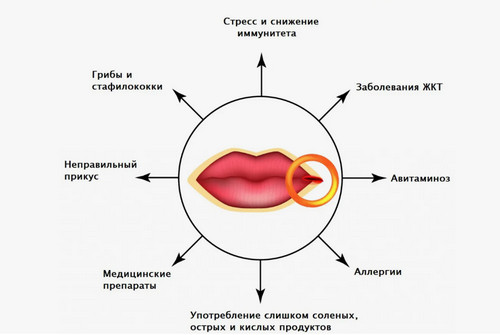 Причины заед в уголке рта