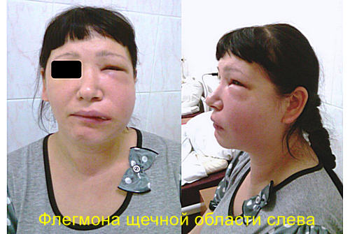 Патогенез флегмоны