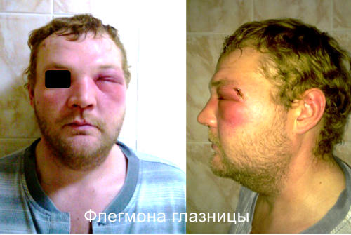 Осложнения