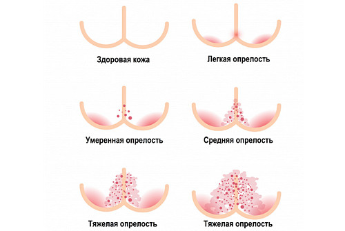 Симптомы опрелостей