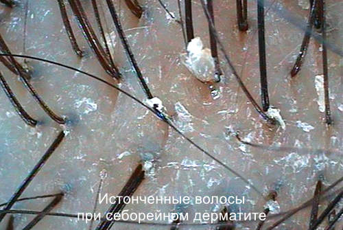 Десквамация и перхоть при СД