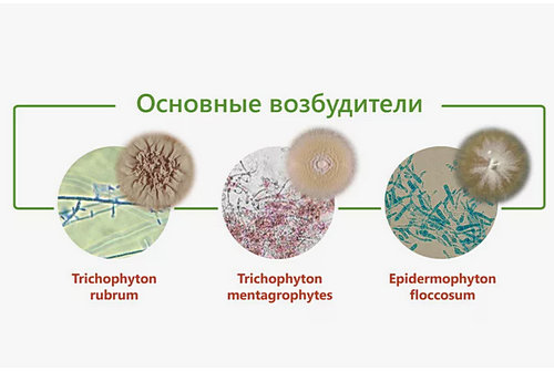 Симптомы микоза