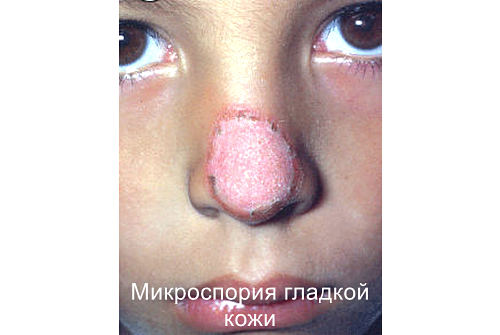 Поверхностные и кожные микозы