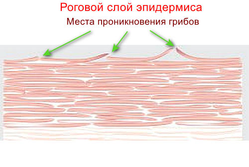 Поражение кожи грибками