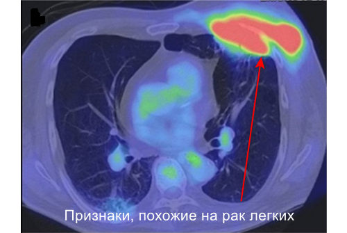 Ошибки диагностики актиномикоза
