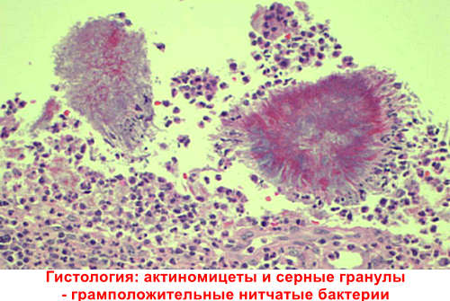 Диагностика актиномикоза