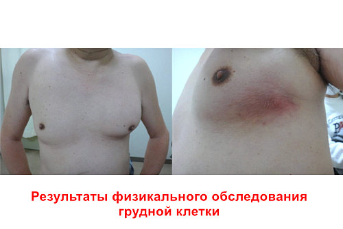 Абдоминальный актиномикоз