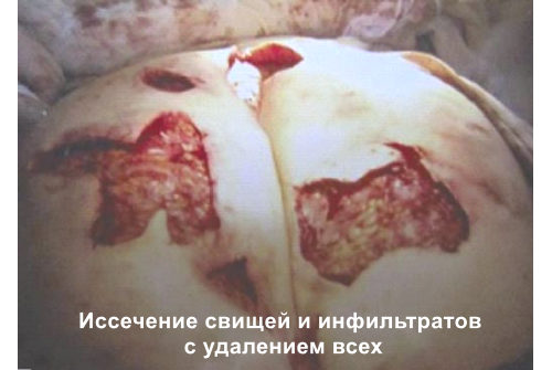 Формы актиномикоза
