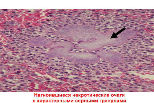Актиномикоз что это