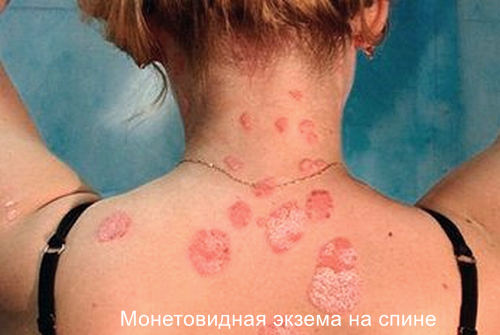 Микробная экзема причины