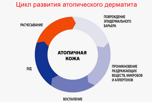 Атопическая экзема симптомы