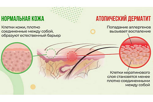 Атопическая экзема патогенез