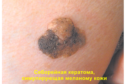 Варианты названия себорейного кератоза