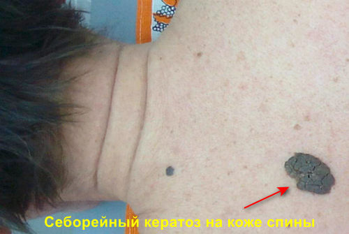 Себорейный кератоз кожи причины
