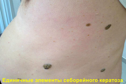 Себорейный кератоз симптомы