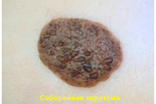 Себорейный кератоз патогенез