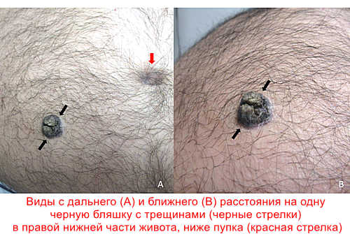 Себорейный кератоз диагностика