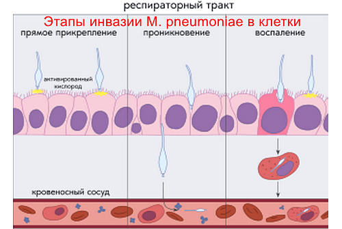 Микоплазменная пневмония патогенез