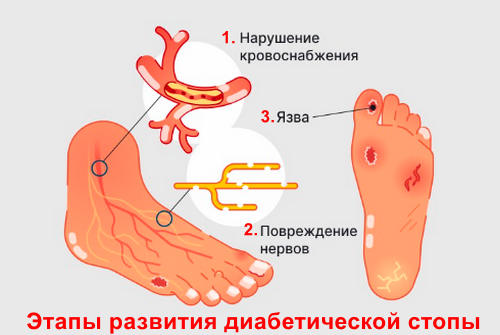 этапы развития диабетической стопы