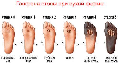 Сухая гангрена стопы