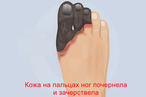 Осложнения диабетической стопы