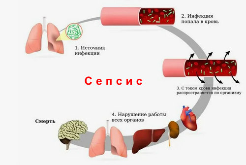 Причины сепсиса