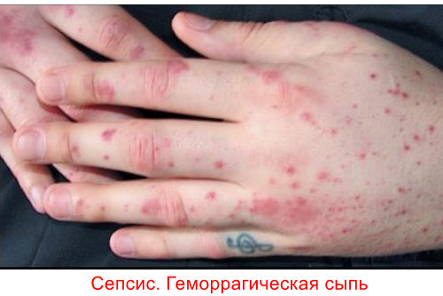 Диагностика сепсиса особенности