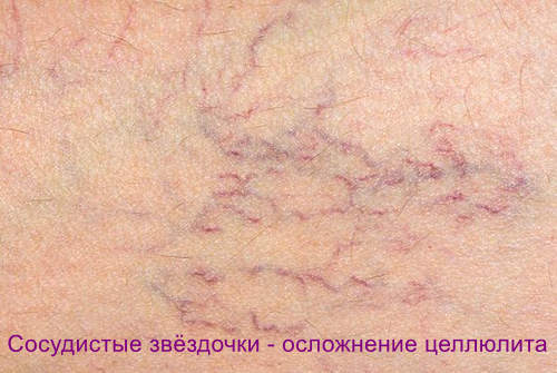 Осложнения целлюлита
