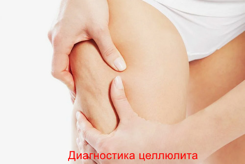 Диагностика целлюлита