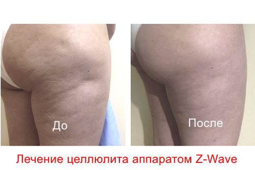 Акустическая волновая терапия