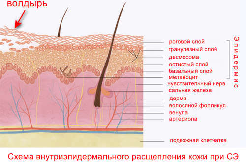 Причины стафилококкового эпидермолиза