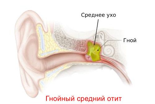 Гнойный средний отит