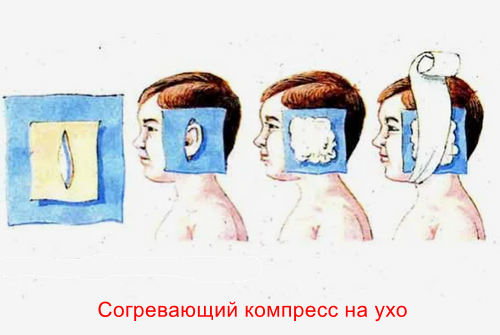 Виды компрессов