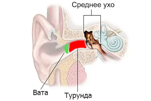 Компресс по Цитовичу на ухо