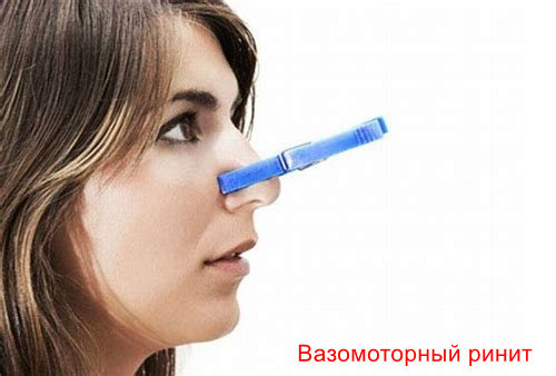 Вазомоторный ринит что это