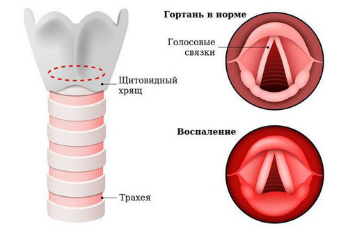 Что такое ларингит