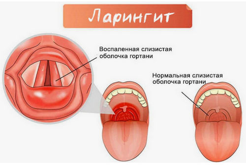 Ларингит причины