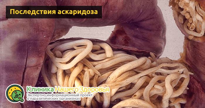Аскаридоз: описание болезни, симптомы, диагностика и лечение
